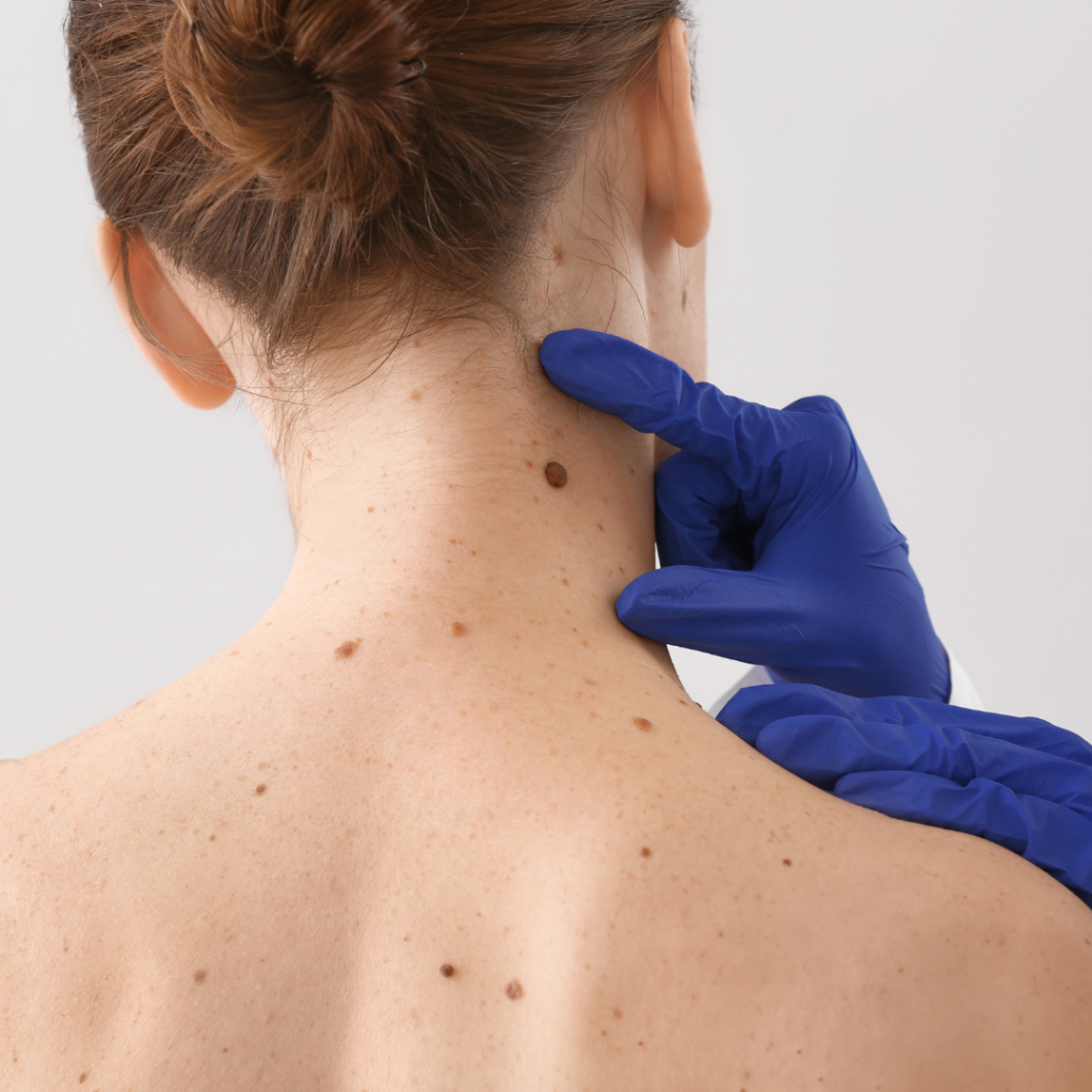 Canberra Clinic Plus Trusted Skin Checks and NonScalpel Vasectomy
